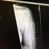 Broken Humerous X-Ray