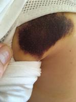 Bruised Shoulder